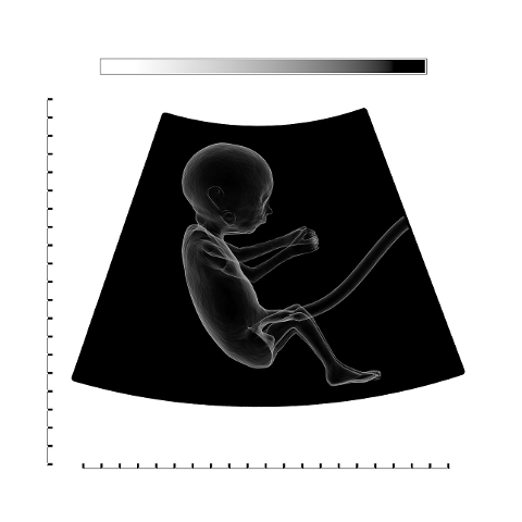 ultrasound-fetus-embryo-placenta-4536368